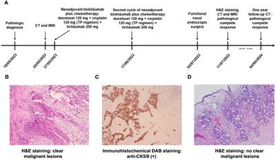 Complete remission in a patient with sinonasal squamous cell carcinoma receiving neoadjuvant tislelizumab plus chemotherapy: a case report